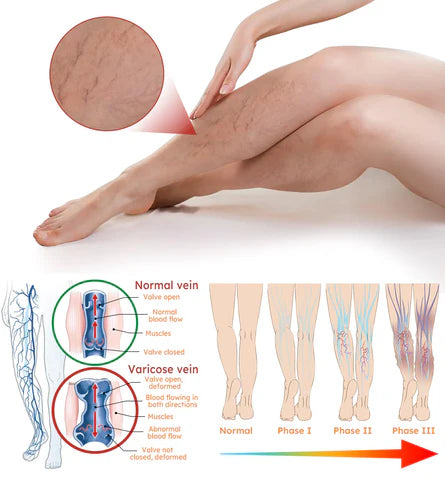 Turmeric Varicose Vein Patches (Buy 1 Get 1 Free)